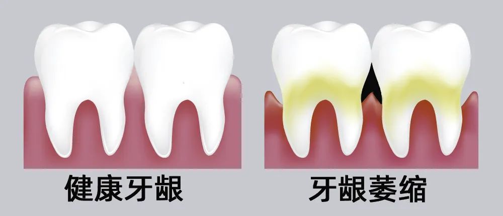 牙縫大露出“黑三角”，既塞牙又難看！還能恢復(fù)嗎？